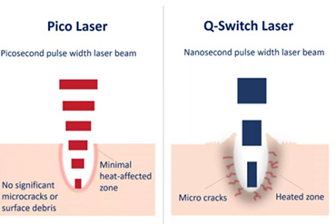 Pico Wave Laser Teknolojisi 