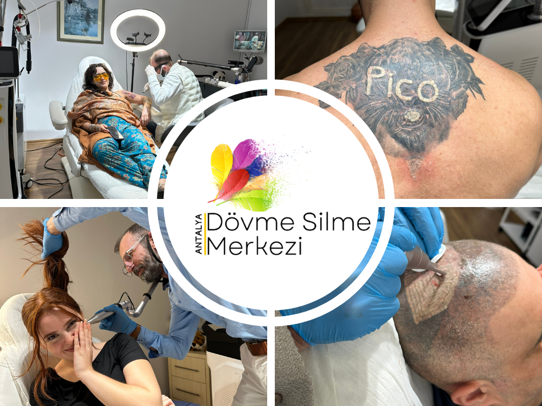 Dövme Silme Sonrası Cilt Bakımı: Dikkat Edilmesi Gerekenler