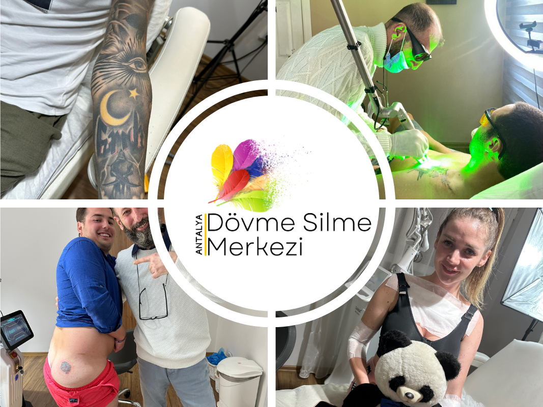 Why Antalya Tattoo Removal Center Is the Best Choice for Safe and Scar-Free Tattoo Removal / Почему Центр Удаления Татуировок в Анталии — Лучший Выбор для Безопасного Удаления Тату без Шрамов